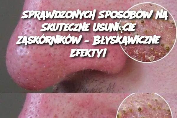 5 Sprawdzonych Sposobów na Skuteczne Usunięcie Zaskórników – Błyskawiczne Efekty!